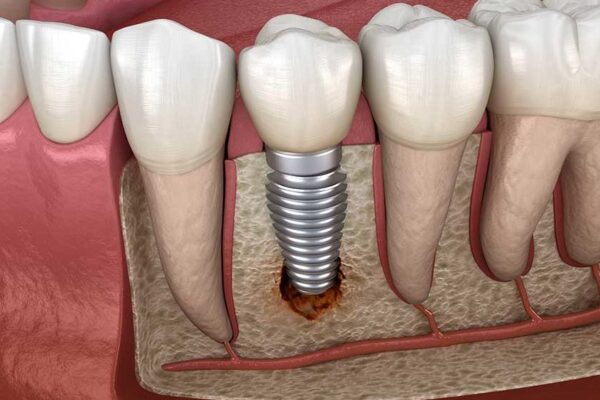 Dental Implant Cost