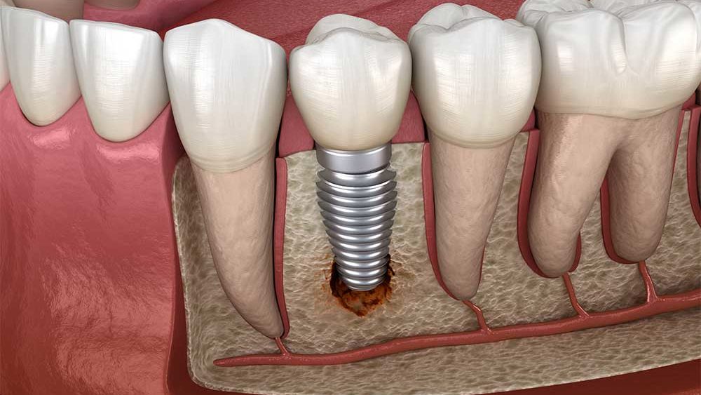 Dental Implant Cost