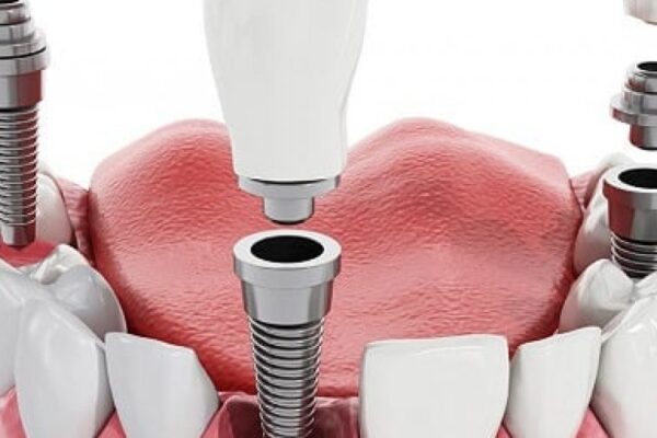 Dental Implants Melbourne