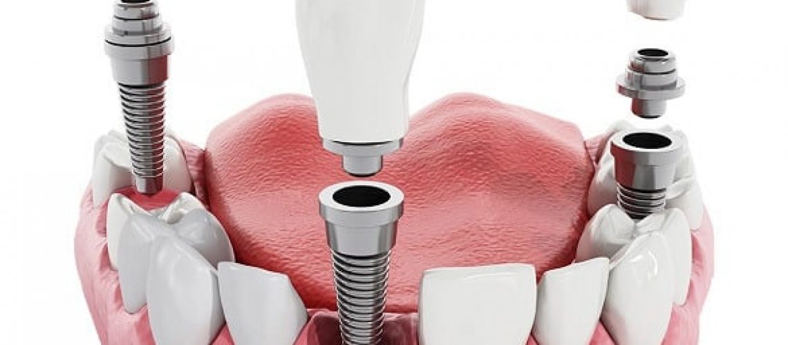 Dental Implants Melbourne