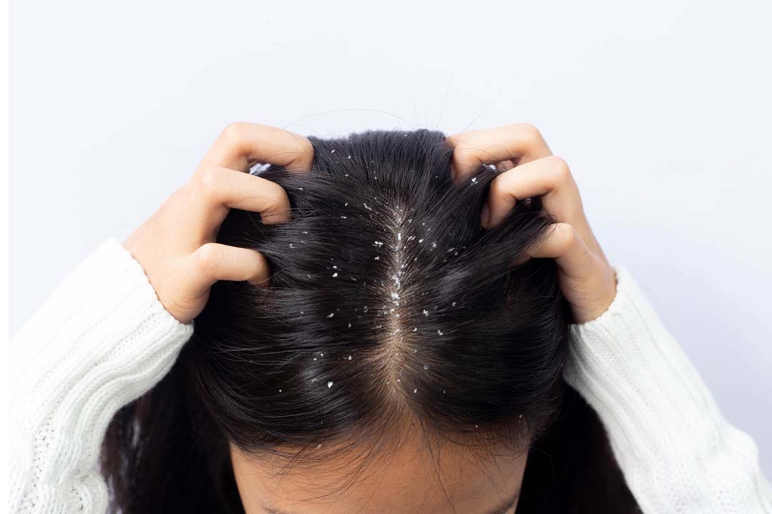 Bottles of popular anti-dandruff shampoo and traditional hair oils displayed against a backdrop symbolizing Pakistan's rich hair care culture.