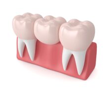 dental bridge services