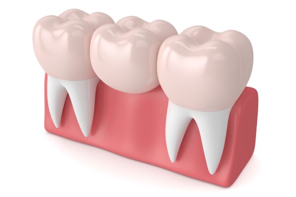 dental bridge services