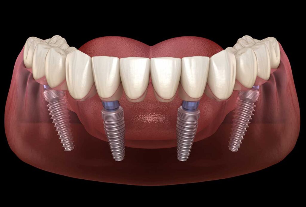 dental implant cost