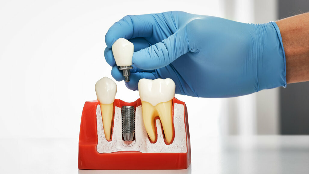 dental implants cost in london