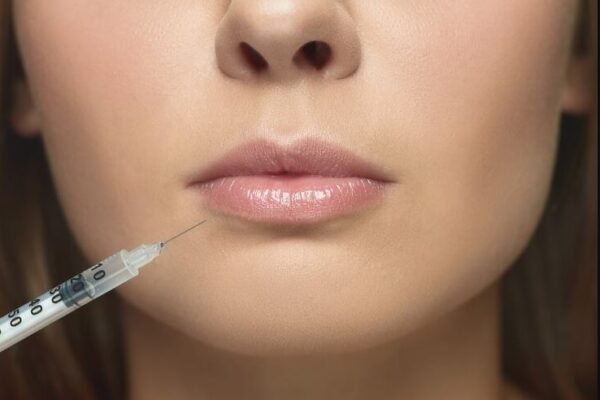 Botox Lip Flip