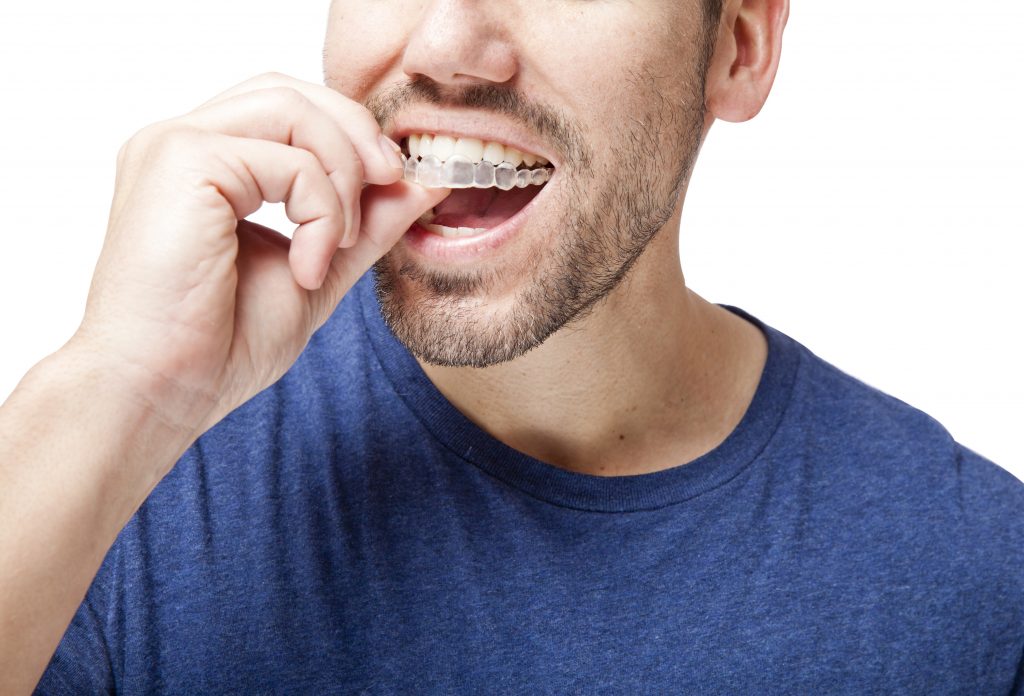 Invisalign London Ontario