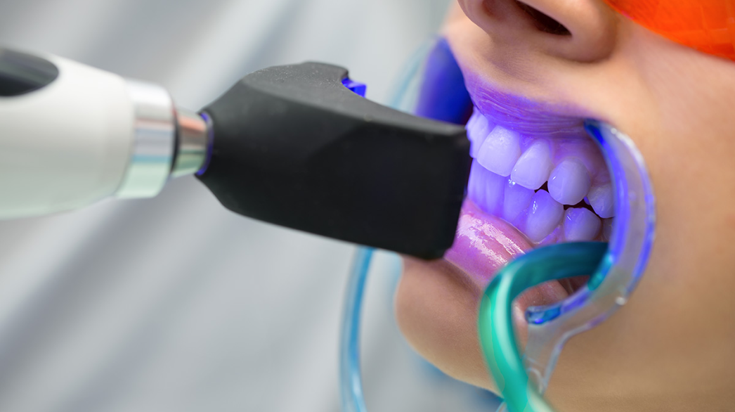 teeth whitening in london ontarion