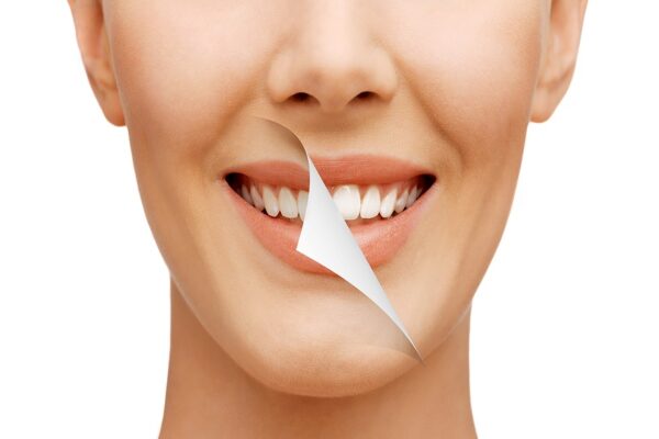 teeth whitening London Ontario